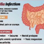 CDC Sounds the Alarm as Drug-Resistant Shigella Cases Surge Across America – What Every Family Needs to Know to Stay Protected