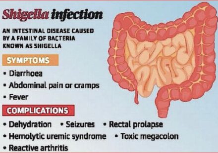 CDC Sounds the Alarm as Drug-Resistant Shigella Cases Surge Across America – What Every Family Needs to Know to Stay Protected